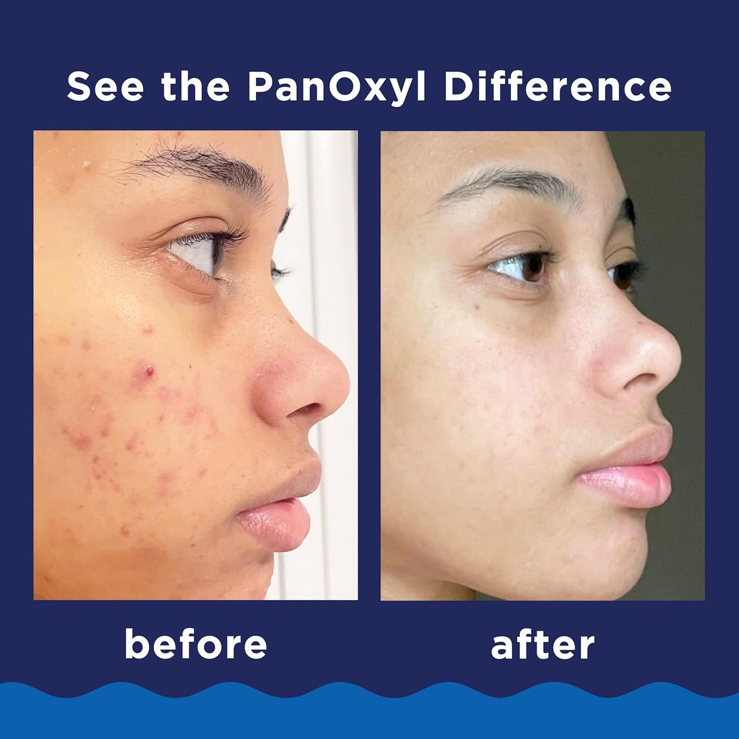 PanOxyl Acne Creamy Wash Benzoyl Peroxide 4%