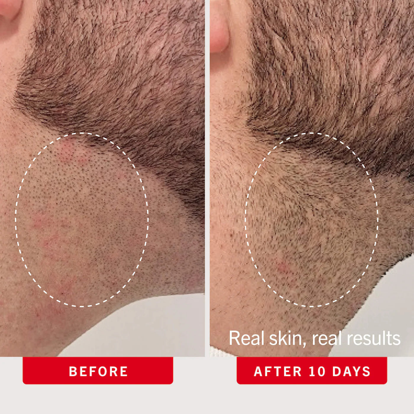 Ingrown Hair Pads with AHA + BHA for Body + Face